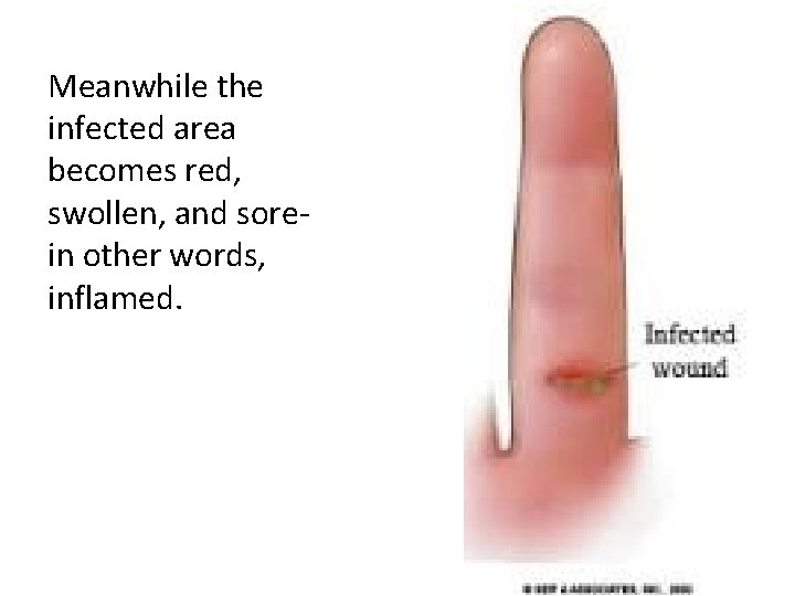 Meanwhile the infected area becomes red, swollen, and sorein other words, inflamed. 