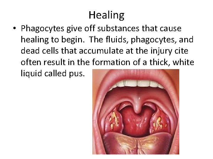 Healing • Phagocytes give off substances that cause healing to begin. The fluids, phagocytes,
