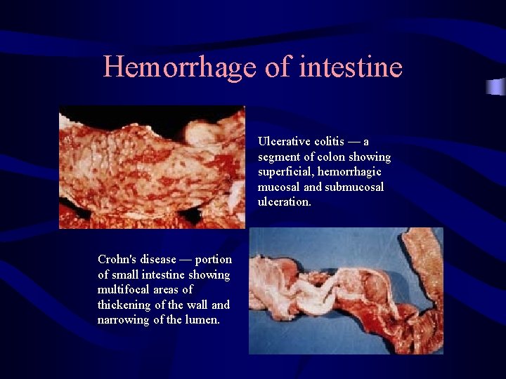 Hemorrhage of intestine Ulcerative colitis — a segment of colon showing superficial, hemorrhagic mucosal