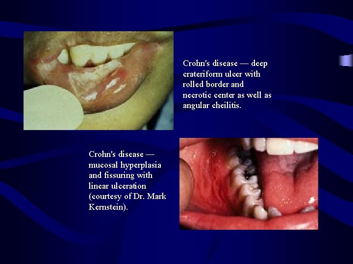 Crohn's disease — deep crateriform ulcer with rolled border and necrotic center as well