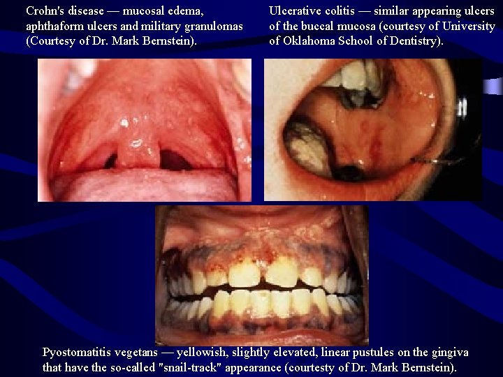Crohn's disease — mucosal edema, aphthaform ulcers and military granulomas (Courtesy of Dr. Mark