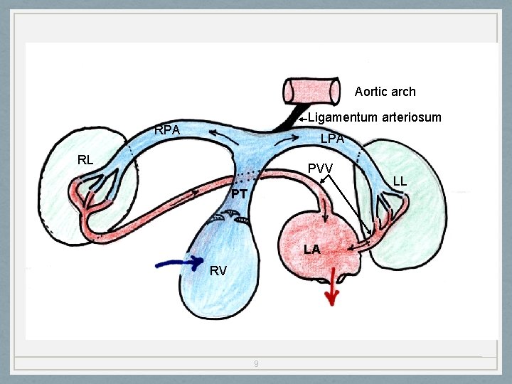 Aortic arch Ligamentum arteriosum RPA LPA RL PVV PT LA RV 9 LL 