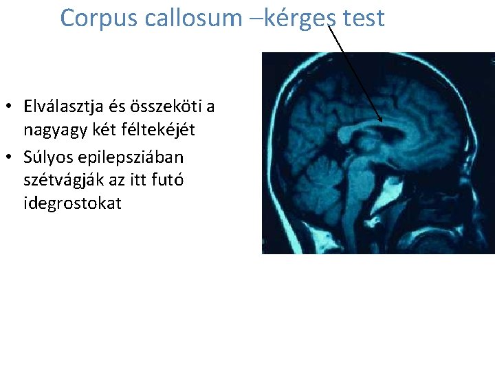 Corpus callosum –kérges test • Elválasztja és összeköti a nagyagy két féltekéjét • Súlyos Corpus callosum –kérges test • Elválasztja és összeköti a nagyagy két féltekéjét • Súlyos