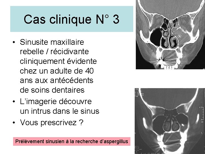 Cas clinique N° 3 • Sinusite maxillaire rebelle / récidivante cliniquement évidente chez un