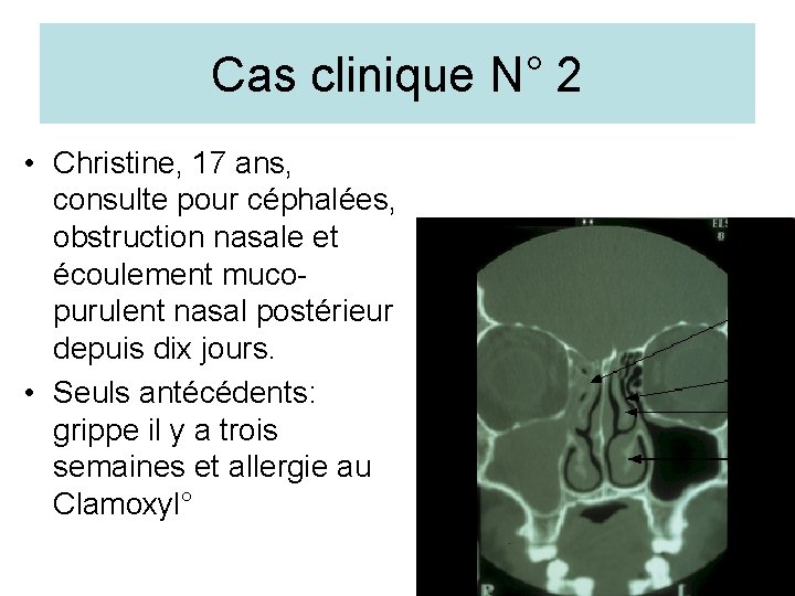 Cas clinique N° 2 • Christine, 17 ans, consulte pour céphalées, obstruction nasale et