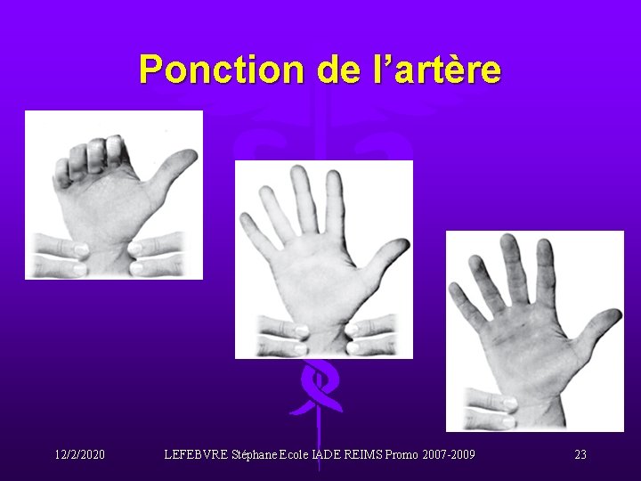 Ponction de l’artère 12/2/2020 LEFEBVRE Stéphane Ecole IADE REIMS Promo 2007 -2009 23 
