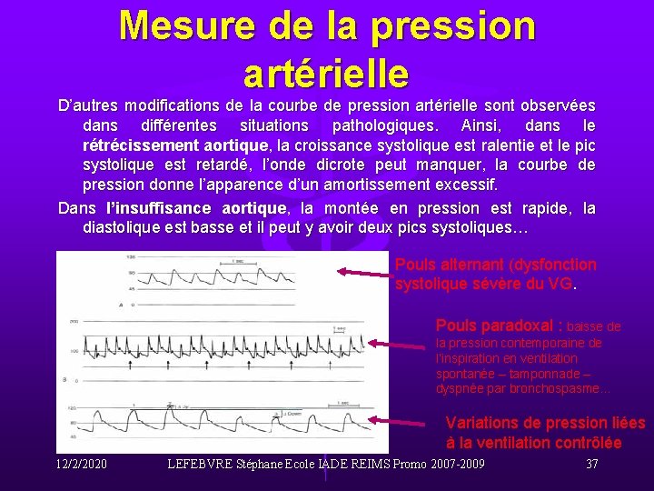 Mesure de la pression artérielle D’autres modifications de la courbe de pression artérielle sont