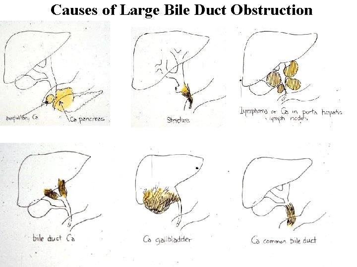 Causes of Large Bile Duct Obstruction 
