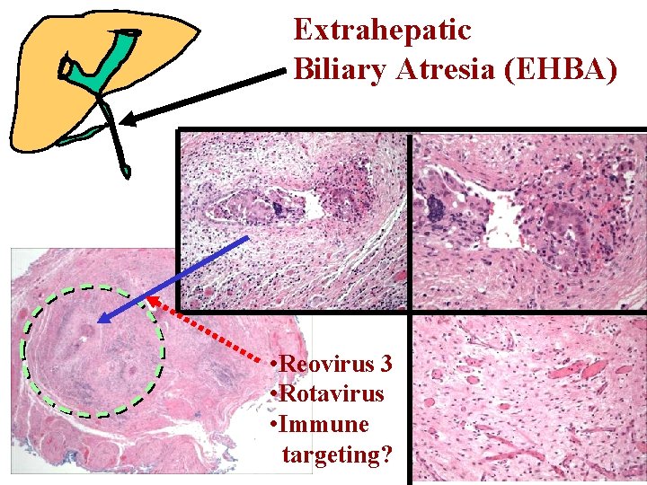 Extrahepatic Biliary Atresia (EHBA) • Reovirus 3 • Rotavirus • Immune targeting? 