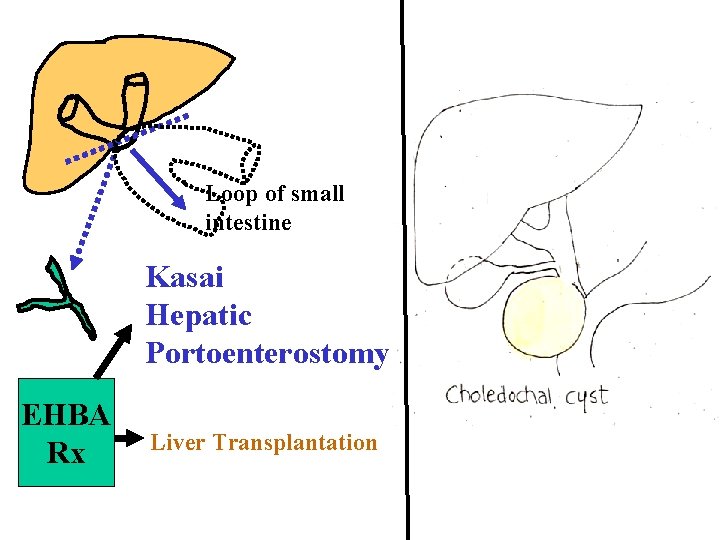 Loop of small intestine Kasai Hepatic Portoenterostomy EHBA Rx Liver Transplantation 