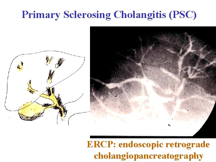 Primary Sclerosing Cholangitis (PSC) ERCP: endoscopic retrograde cholangiopancreatography 