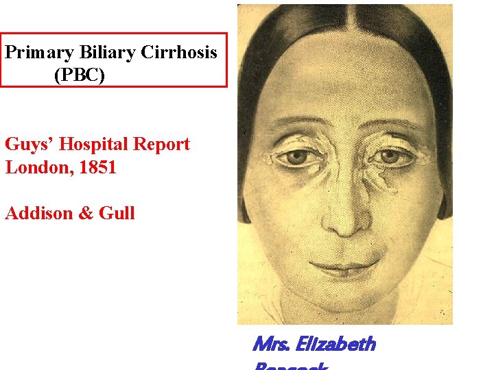 Primary Biliary Cirrhosis (PBC) Guys’ Hospital Report London, 1851 Addison & Gull Mrs. Elizabeth