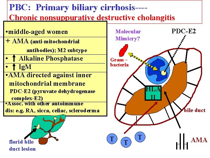 PBC: Primary biliary cirrhosis---Chronic nonsuppurative destructive cholangitis • middle-aged women + AMA (anti-mitochondrial PDC-E