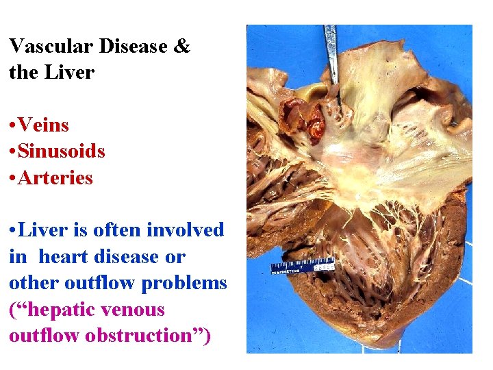 Vascular Disease & the Liver • Veins • Sinusoids • Arteries • Liver is