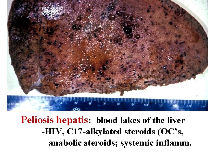 Peliosis hepatis: blood lakes of the liver -HIV, C 17 -alkylated steroids (OC’s, anabolic