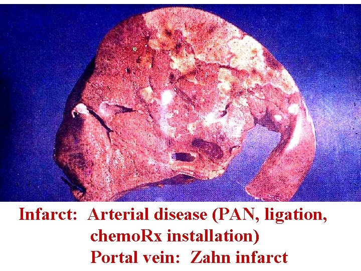 Infarct: Arterial disease (PAN, ligation, chemo. Rx installation) Portal vein: Zahn infarct 