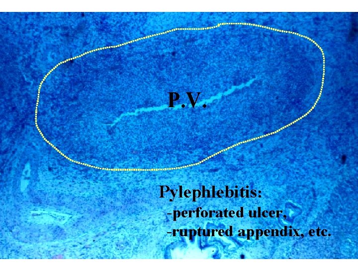 P. V. Pylephlebitis: -perforated ulcer, -ruptured appendix, etc. 