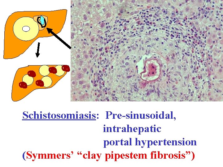 Schistosomiasis: Pre-sinusoidal, intrahepatic portal hypertension (Symmers’ “clay pipestem fibrosis”) 