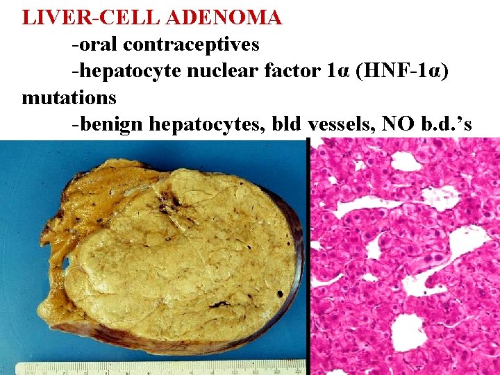 LIVER-CELL ADENOMA -oral contraceptives -hepatocyte nuclear factor 1α (HNF-1α) mutations -benign hepatocytes, bld vessels,