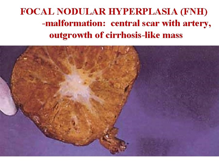 FOCAL NODULAR HYPERPLASIA (FNH) -malformation: central scar with artery, outgrowth of cirrhosis-like mass 