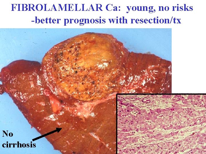 FIBROLAMELLAR Ca: young, no risks -better prognosis with resection/tx No cirrhosis 