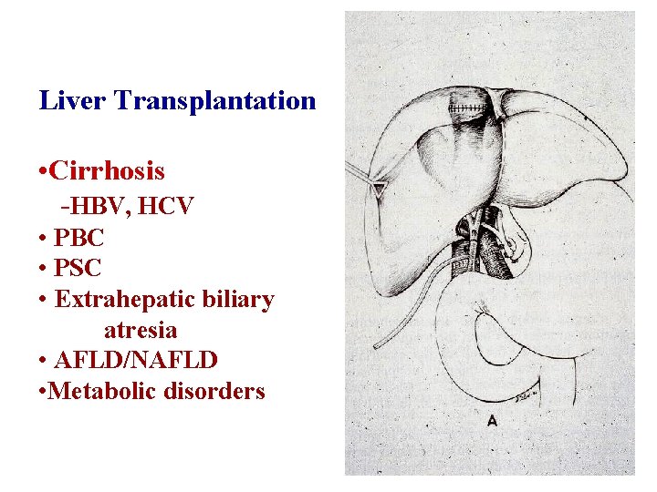 Liver Transplantation • Cirrhosis -HBV, HCV • PBC • PSC • Extrahepatic biliary atresia