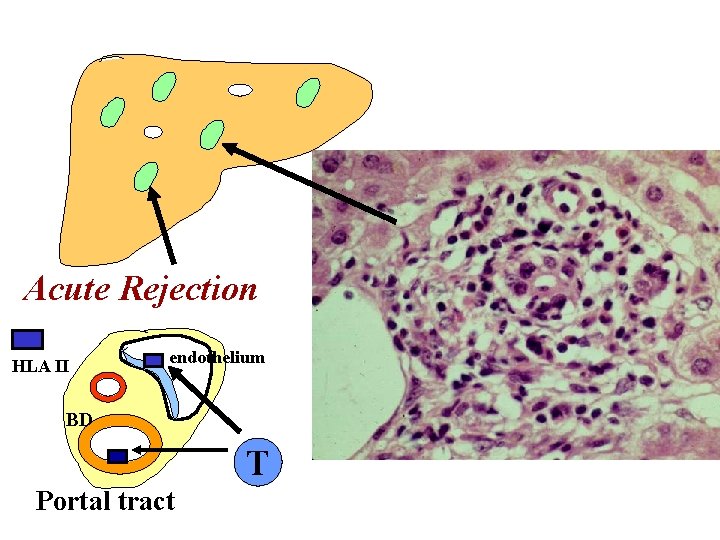 Acute Rejection HLA II endothelium BD T Portal tract 