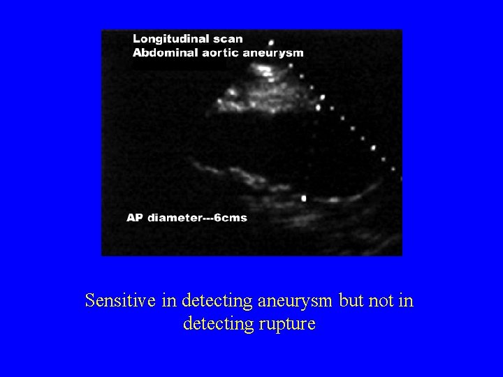 Sensitive in detecting aneurysm but not in detecting rupture 