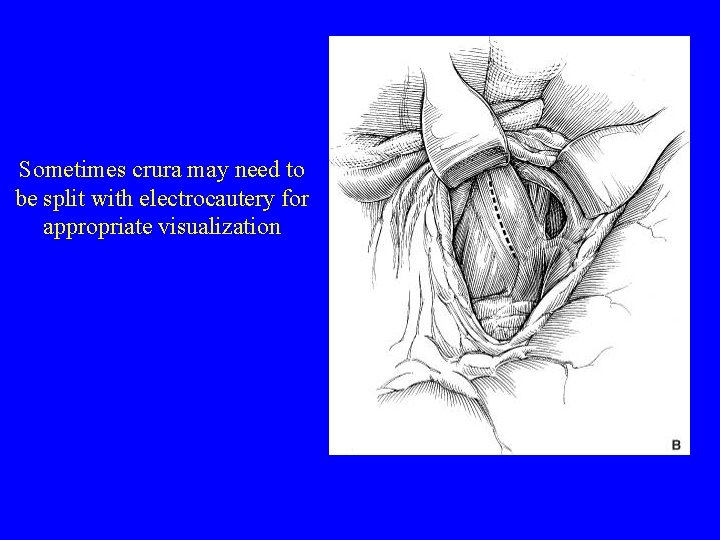 Sometimes crura may need to be split with electrocautery for appropriate visualization 