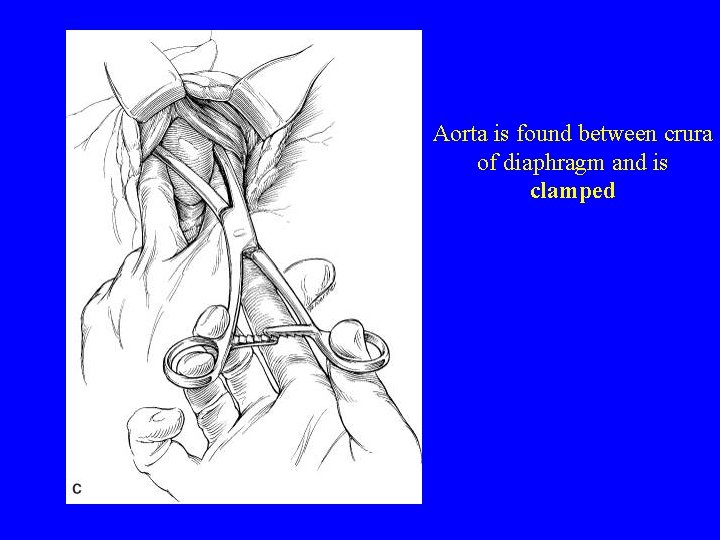 Aorta is found between crura of diaphragm and is clamped 