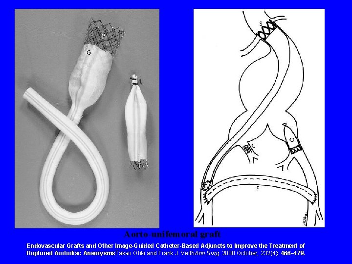 Aorto-unifemoral graft Endovascular Grafts and Other Image-Guided Catheter-Based Adjuncts to Improve the Treatment of