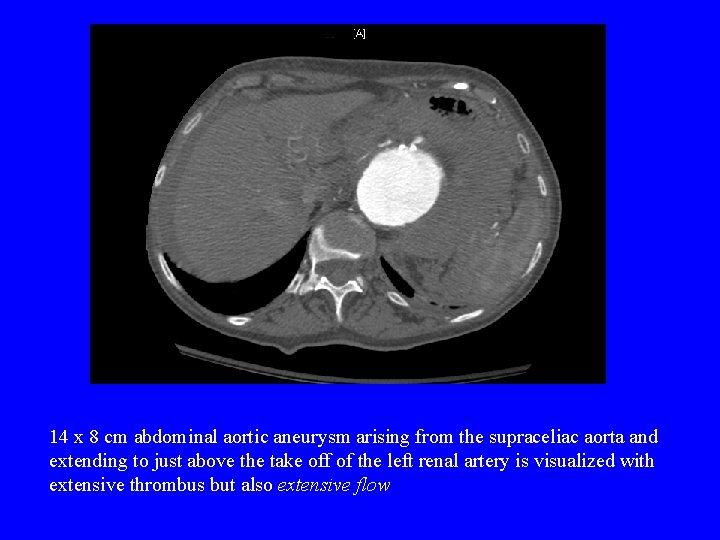 14 x 8 cm abdominal aortic aneurysm arising from the supraceliac aorta and extending