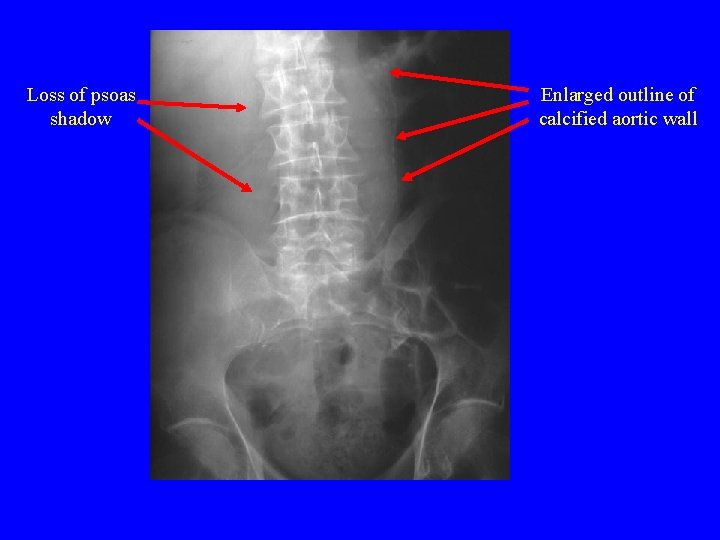 Loss of psoas shadow Enlarged outline of calcified aortic wall 