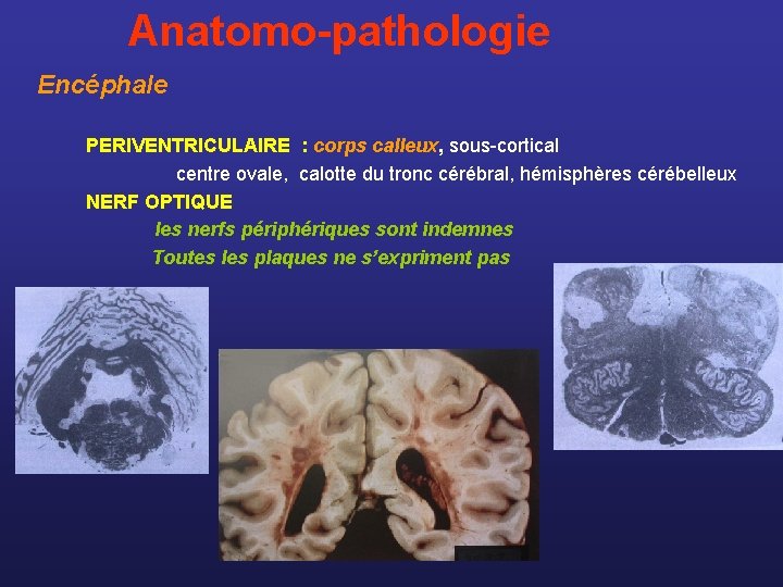  Anatomo-pathologie Encéphale PERIVENTRICULAIRE : corps calleux, sous-cortical centre ovale, calotte du tronc cérébral,