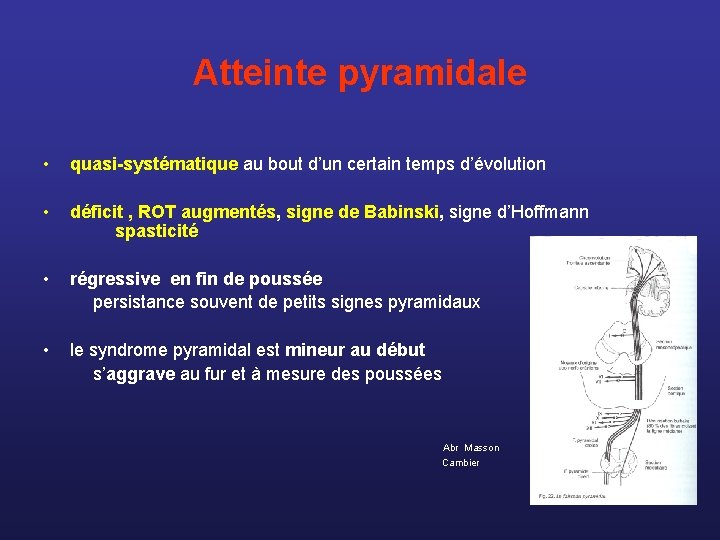 Atteinte pyramidale • quasi-systématique au bout d’un certain temps d’évolution • déficit , ROT