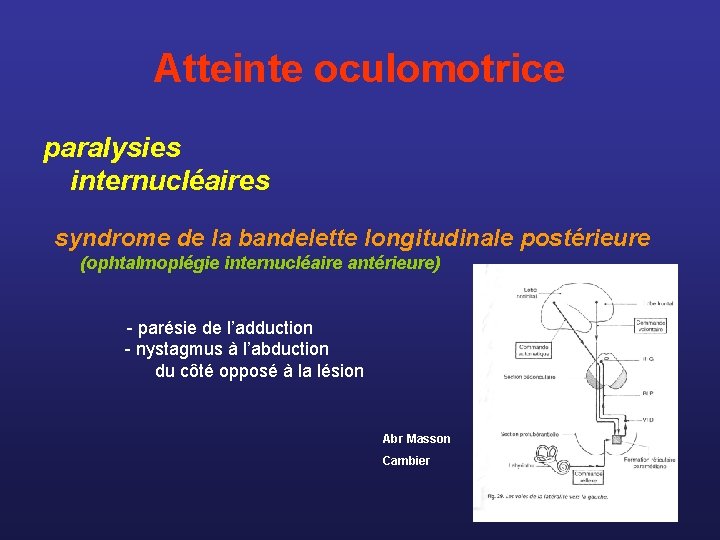 Atteinte oculomotrice paralysies internucléaires syndrome de la bandelette longitudinale postérieure (ophtalmoplégie internucléaire antérieure) -