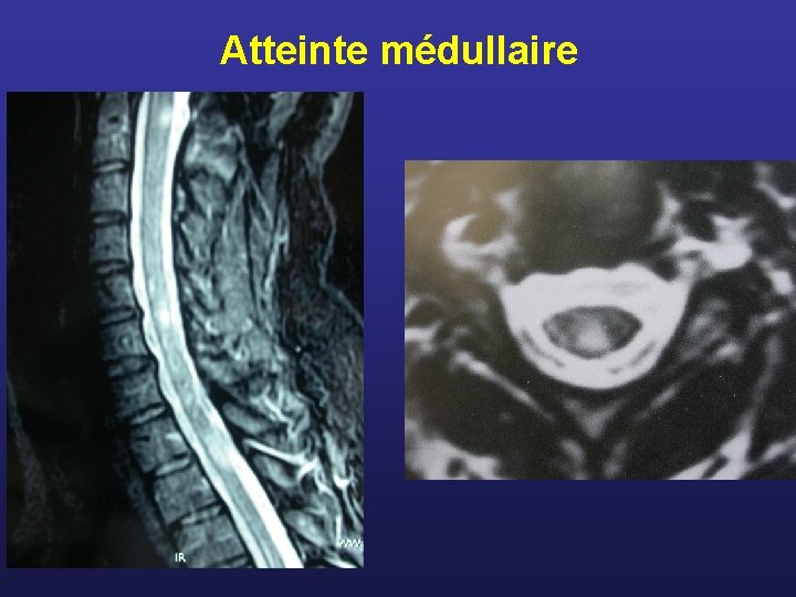 Atteinte médullaire 