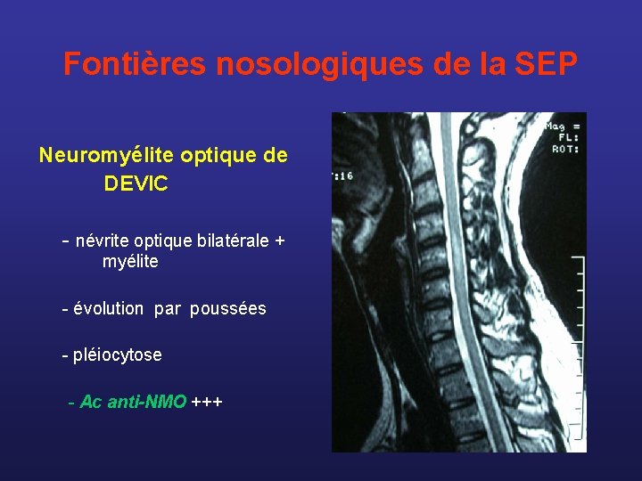 Fontières nosologiques de la SEP Neuromyélite optique de DEVIC - névrite optique bilatérale +