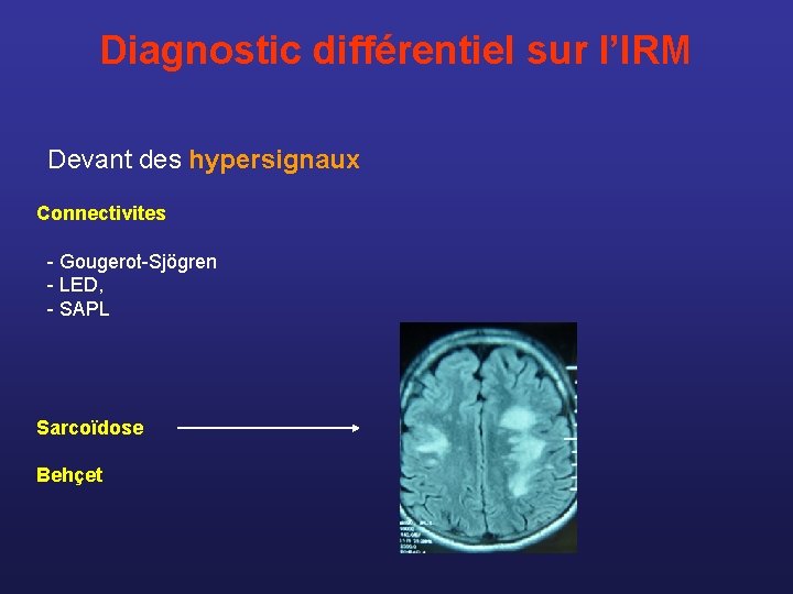 Diagnostic différentiel sur l’IRM Devant des hypersignaux Connectivites - Gougerot-Sjögren - LED, - SAPL