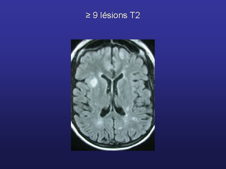 ≥ 9 lésions T 2 