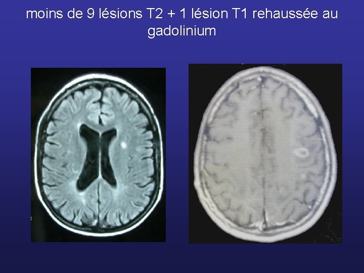 moins de 9 lésions T 2 + 1 lésion T 1 rehaussée au gadolinium