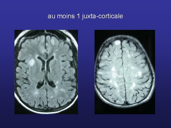 au moins 1 juxta-corticale 