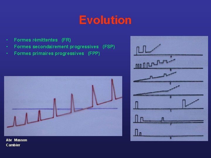 Evolution • • • Formes rémittentes (FR) Formes secondairement progressives (FSP) Formes primaires progressives