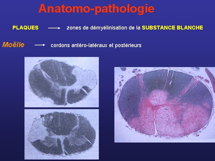  Anatomo-pathologie PLAQUES zones de démyélinisation de la SUBSTANCE BLANCHE Moëlle cordons antéro-latéraux et