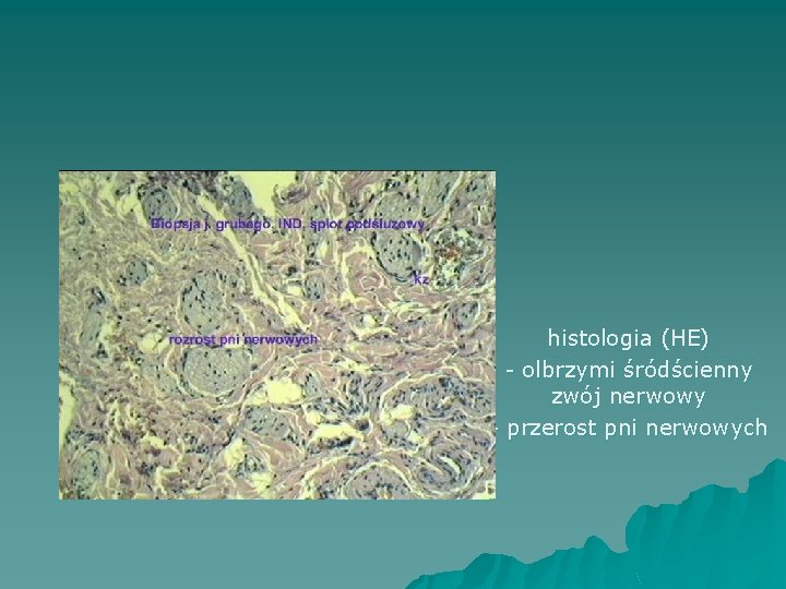IND B histologia (HE) - olbrzymi śródścienny zwój nerwowy - przerost pni nerwowych 