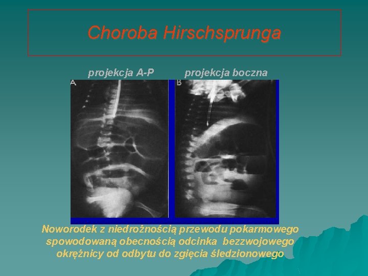 Choroba Hirschsprunga projekcja A-P projekcja boczna Noworodek z niedrożnością przewodu pokarmowego spowodowaną obecnością odcinka