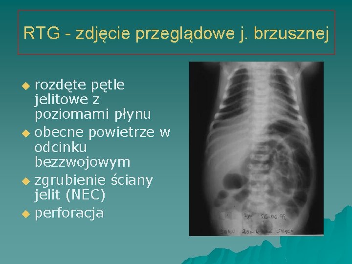 RTG - zdjęcie przeglądowe j. brzusznej rozdęte pętle jelitowe z poziomami płynu u obecne