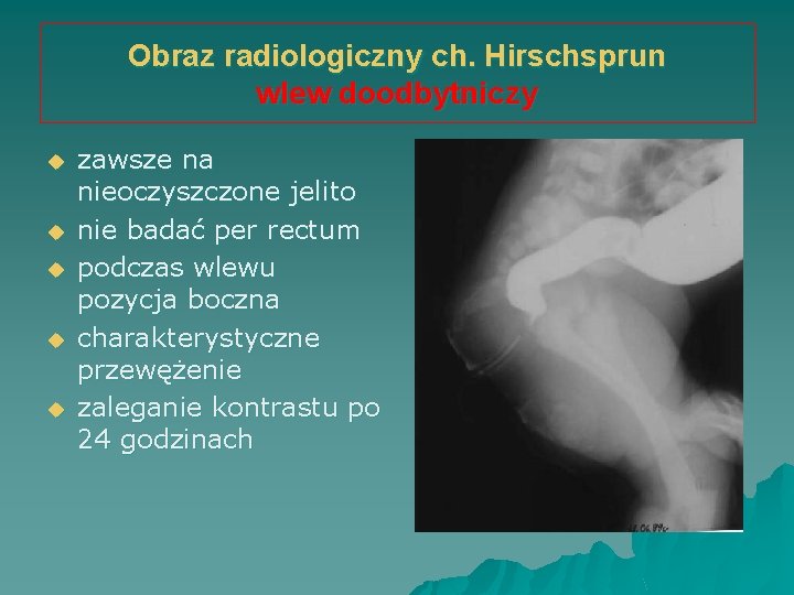 Obraz radiologiczny ch. Hirschsprun wlew doodbytniczy u u u zawsze na nieoczyszczone jelito nie