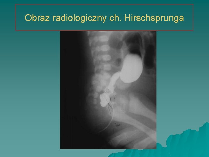 Obraz radiologiczny ch. Hirschsprunga 