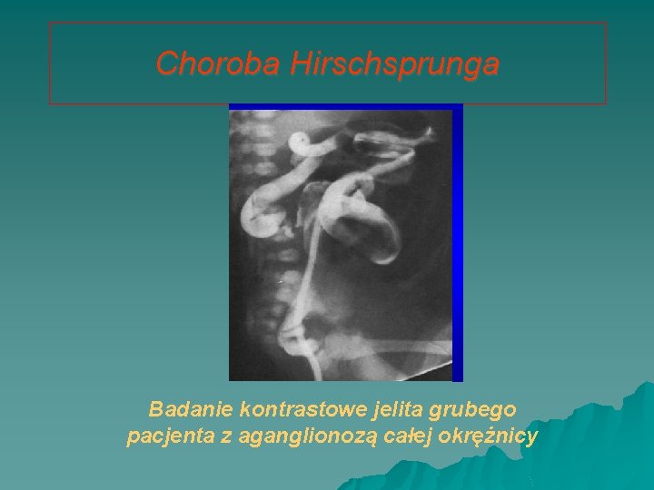 Choroba Hirschsprunga Badanie kontrastowe jelita grubego pacjenta z aganglionozą całej okrężnicy 